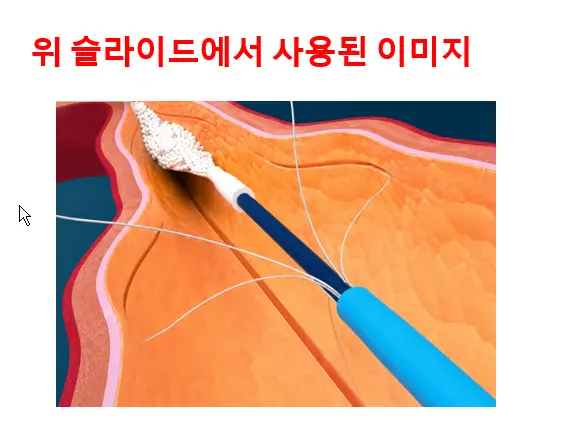 플레보그립